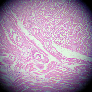 cysts in muscle tissue